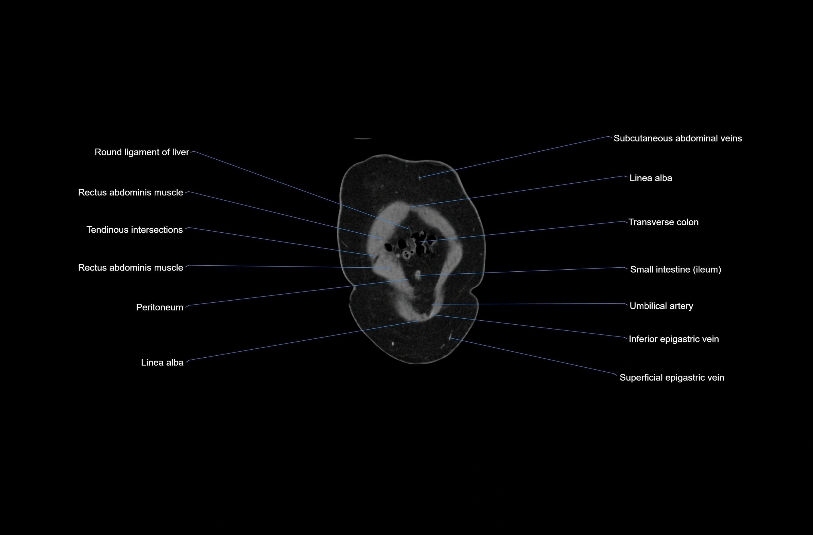 CT abdomen coronal cross sectional anatomy labelled radiology image-00006.webp